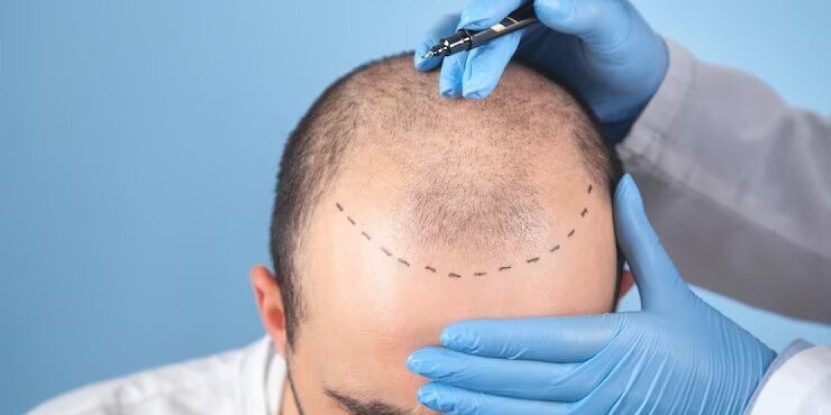 Top Hair Transplant Results: An In-Depth Guide