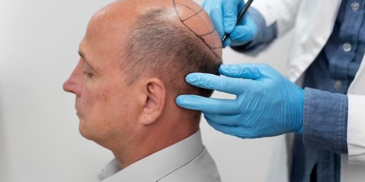 Cuanto Cuesta Un Transplante De Pelo