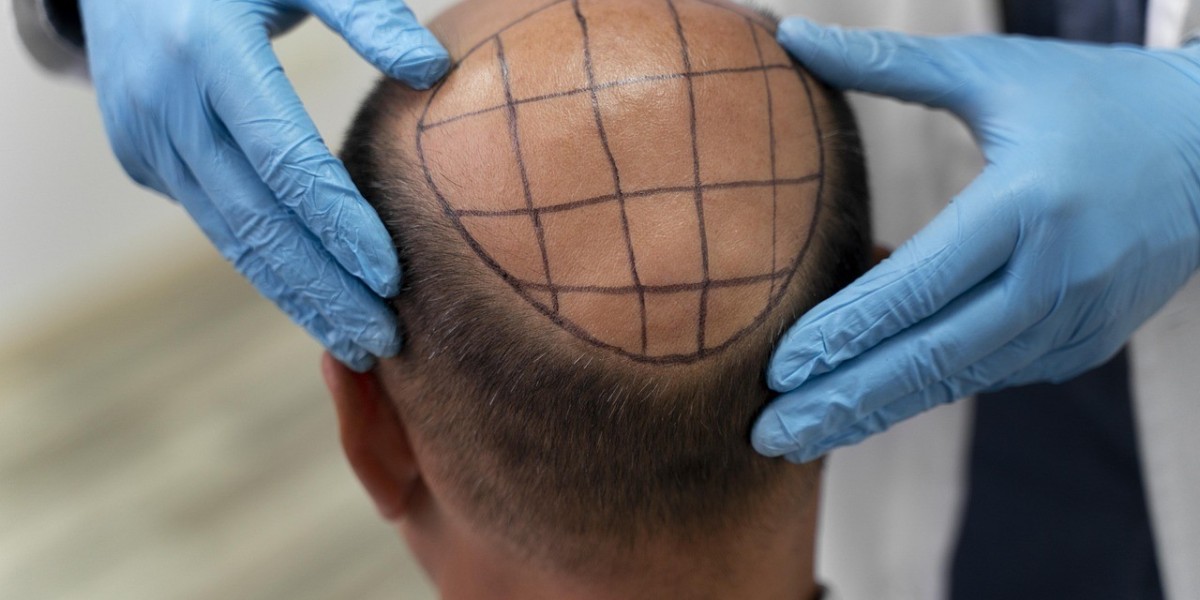 Revitalize Your Look: Best FUE Hair Transplant