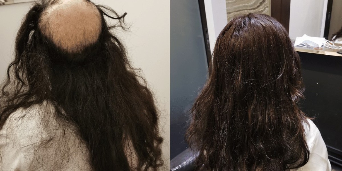 Hair transplant cost singapore