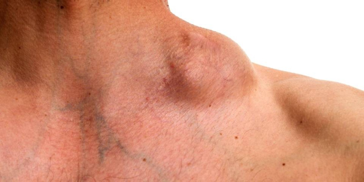 You Can Avoid Lymphoma With These Approaches
