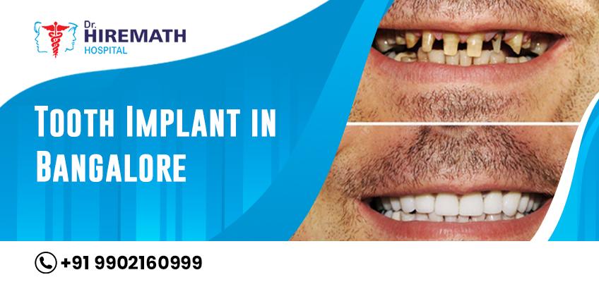 | Dr. Vishwannath Hiremath | DENTAL IMPLANTS