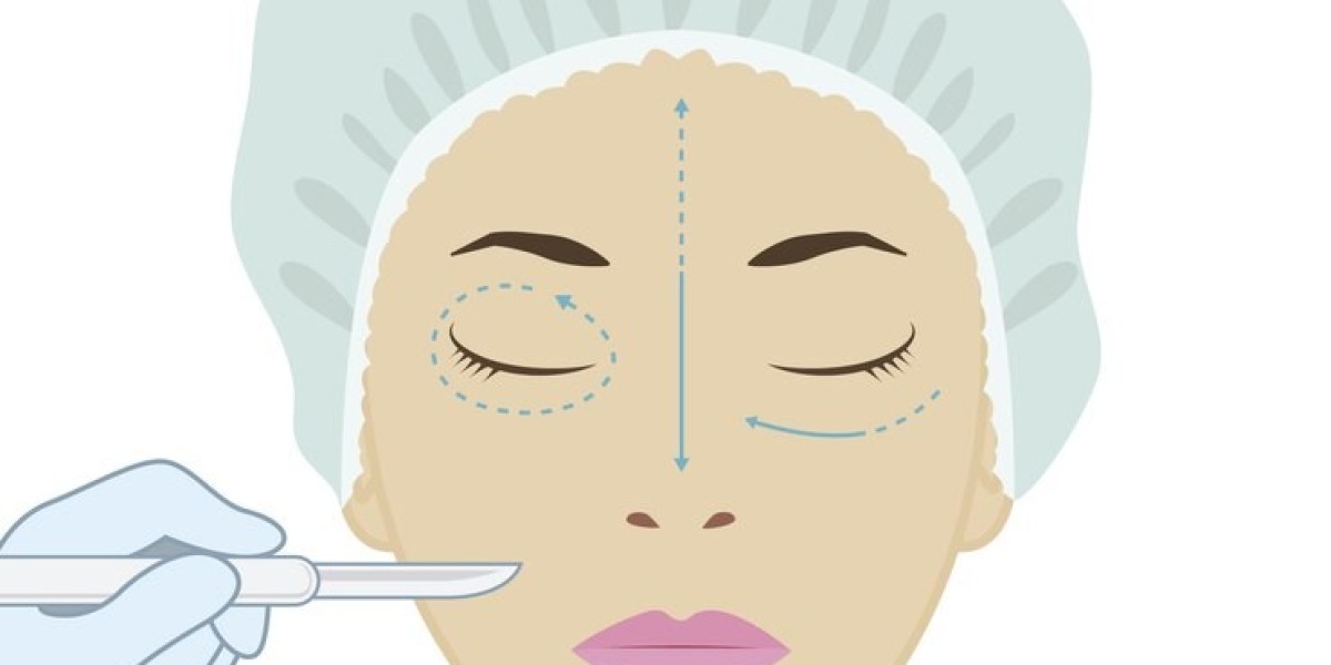 Filler for Marionette Lines: A Comprehensive Guide to Smoothing Your Smile