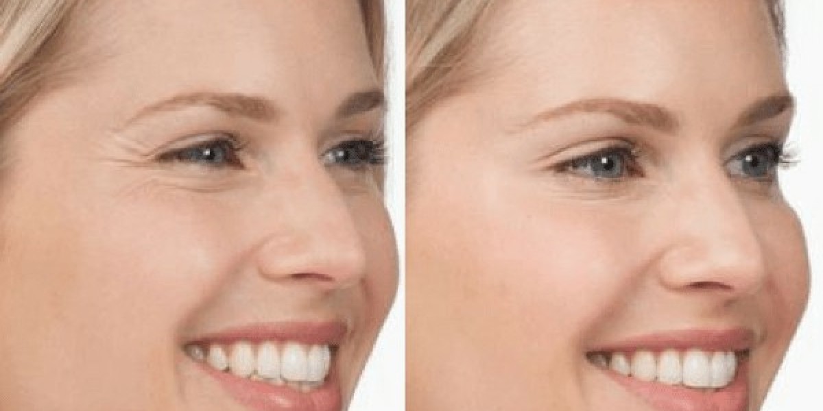 How long does Botox take to start working on average?